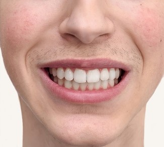 After Braces