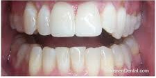 After Dental Crown