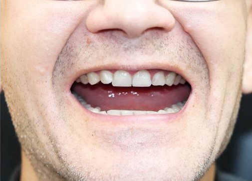 After Dentures