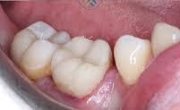 After Filling