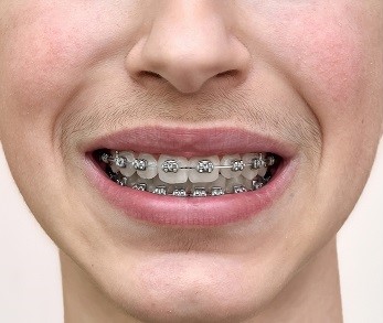 Before Braces