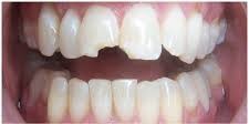 Before Dental Crown