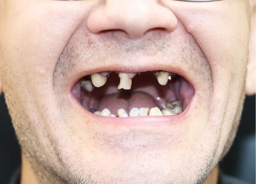 Before Dentures