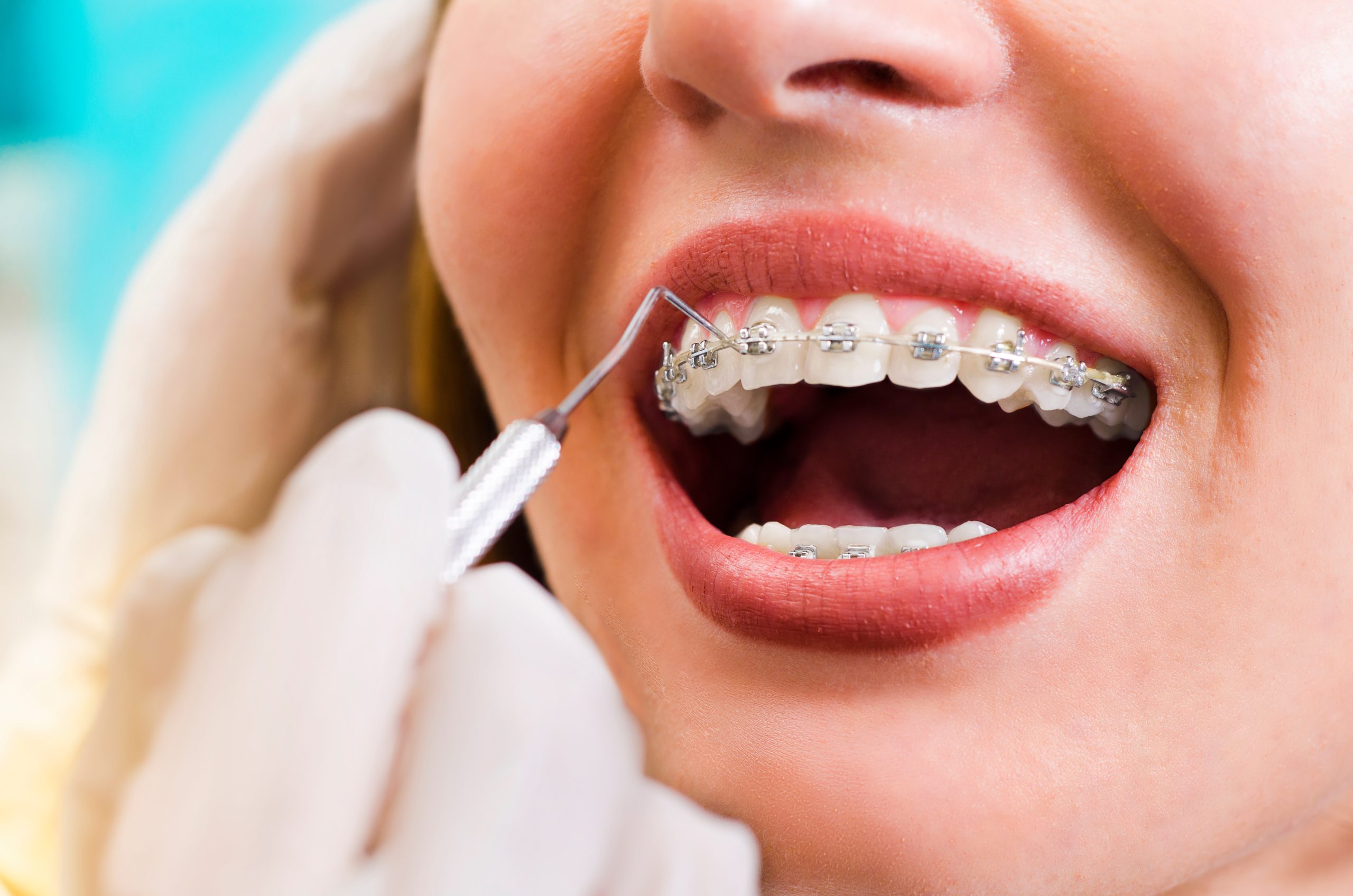Braces and Aligners