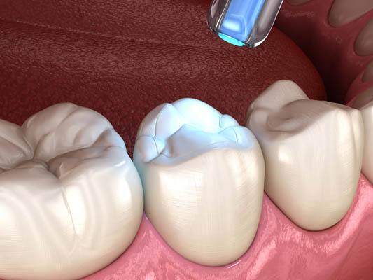 Teeth Fillings