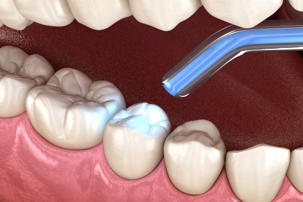 teeth cleaning services